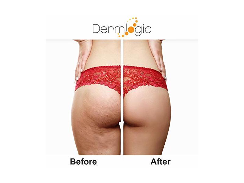 Dermlogic Anti-Acne Thigh & Buttocks Treatment 6.09 oz